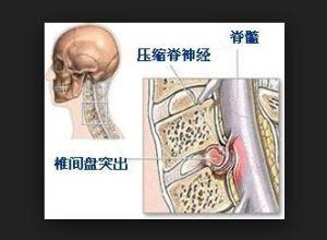 颈椎突出能复位吗?成都中山高新骨科医院好不好?